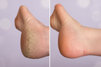 Optimized Before & After Heel